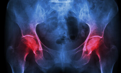 Kako zaustaviti osteoporozu?