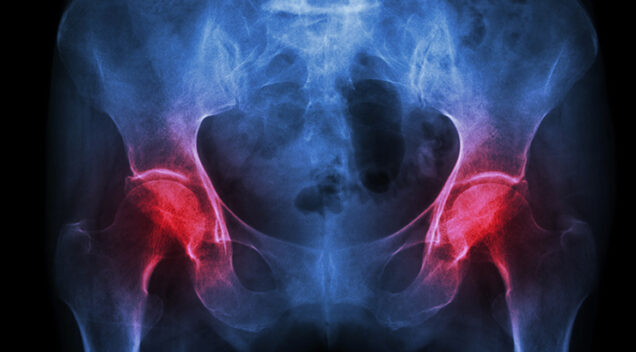 Kako zaustaviti osteoporozu?